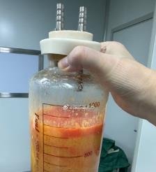 句容水动力吸脂手术要做多久？